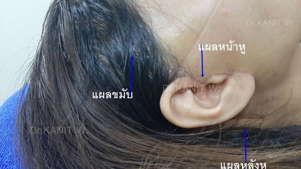 ไขข้อข้องใจ ตำแหน่งแผลผ่าตัดดึงหน้า