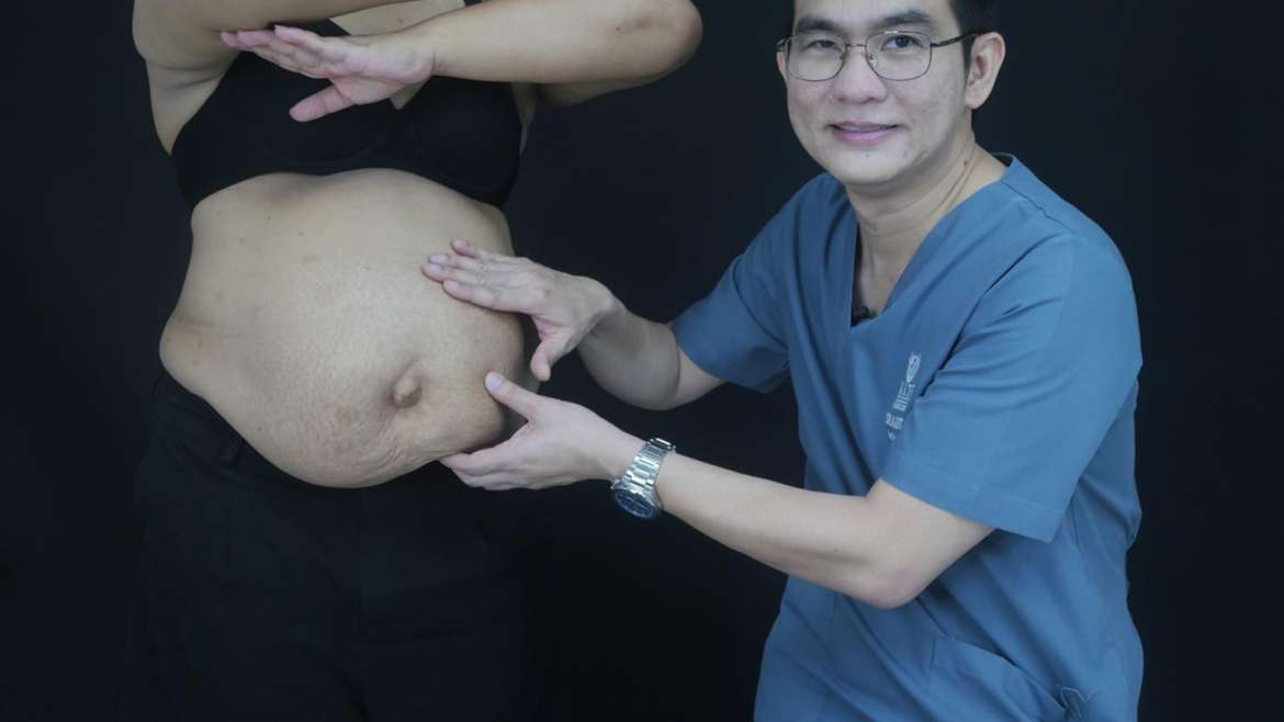 #ผ่าตัดไขมันหน้าท้อง (Tummy Tuck)